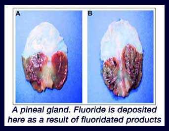 calcified pineal gland
