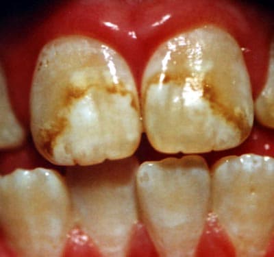 dental_fluorosis-1063